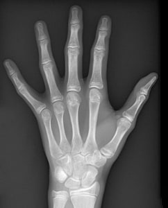 radiographie âge osseux